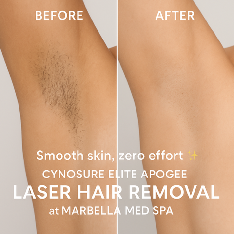 Cynosure Elite Apogee Laser Hair Removal
