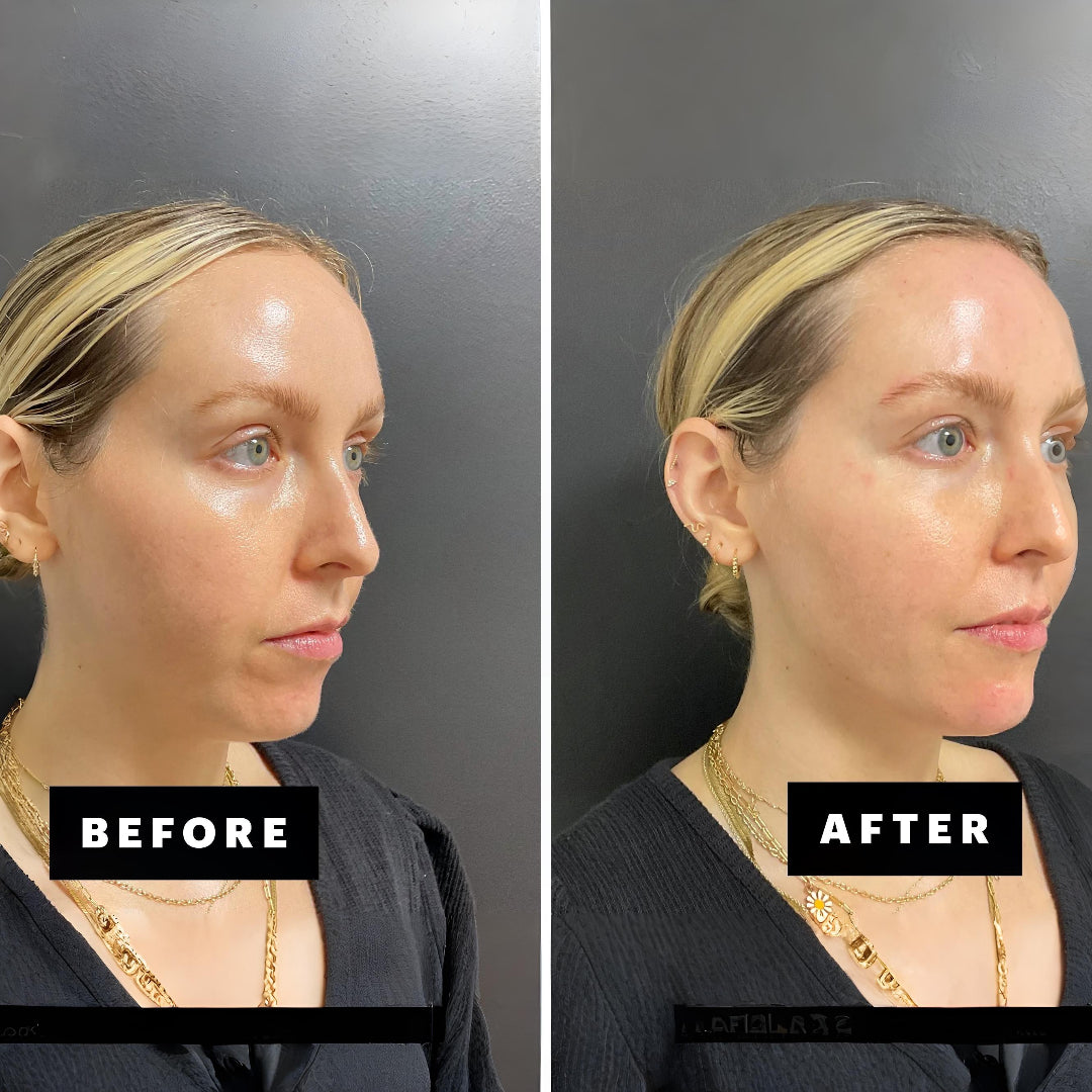 Chin Filler 2 ml – Non-Surgical Contouring & Projection