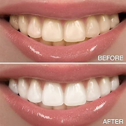 Teeth whitening