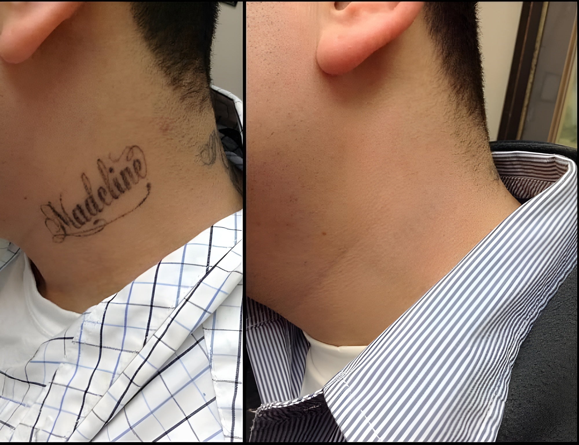 Tattoo remova
