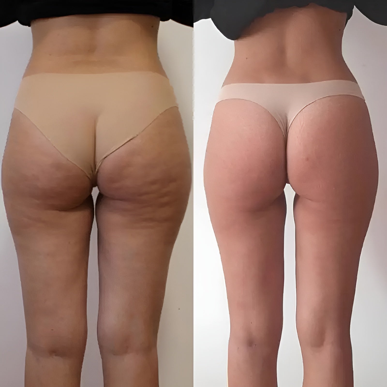 Endosphere therapy